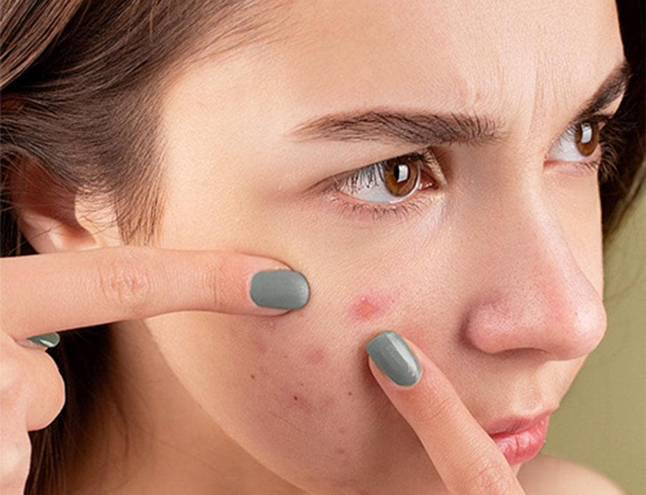 Acne behandeling bij Dermise