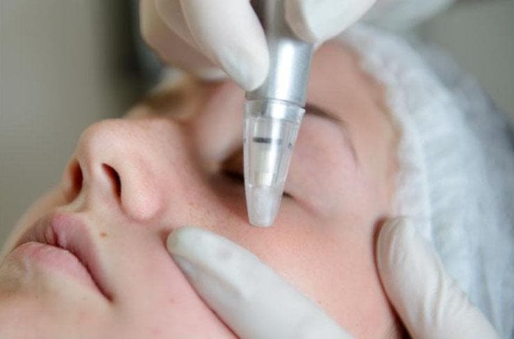 Microdermabrasie behandeling bij Dermise in Assen